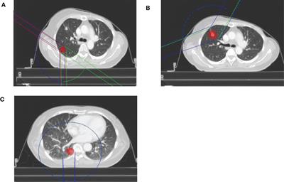 Evaluation of flattening-filter-free and flattening filter dosimetric and radiobiological criteria for lung SBRT: A volume-based analysis